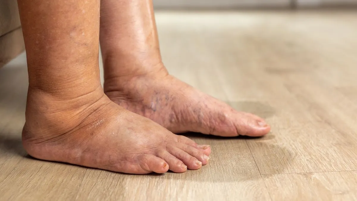 Formigamento nos Pés e Pernas: pode ser diabetes? | Biomed Integra